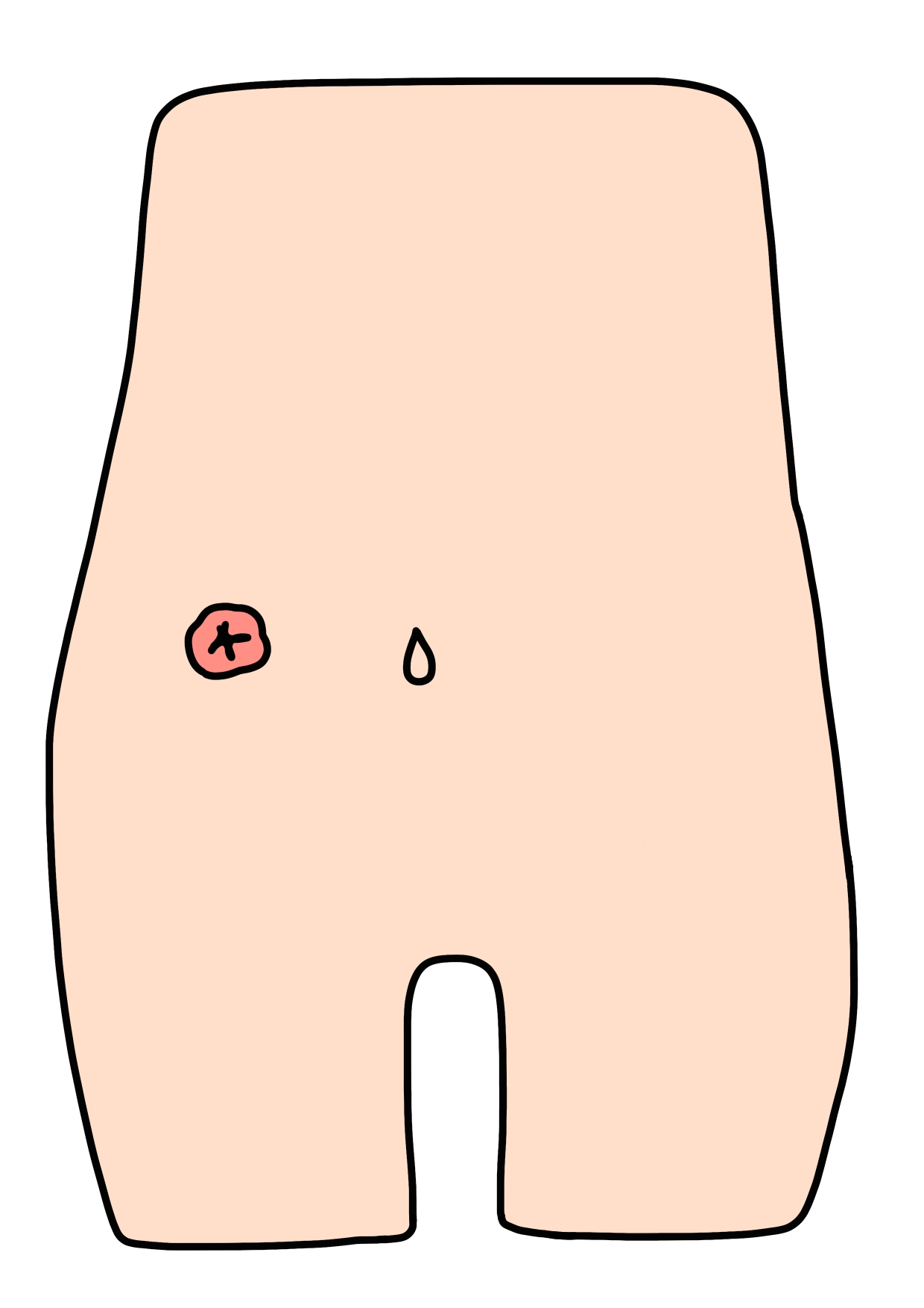 看護記録の書き方の実例　ストーマのセルフケア指導