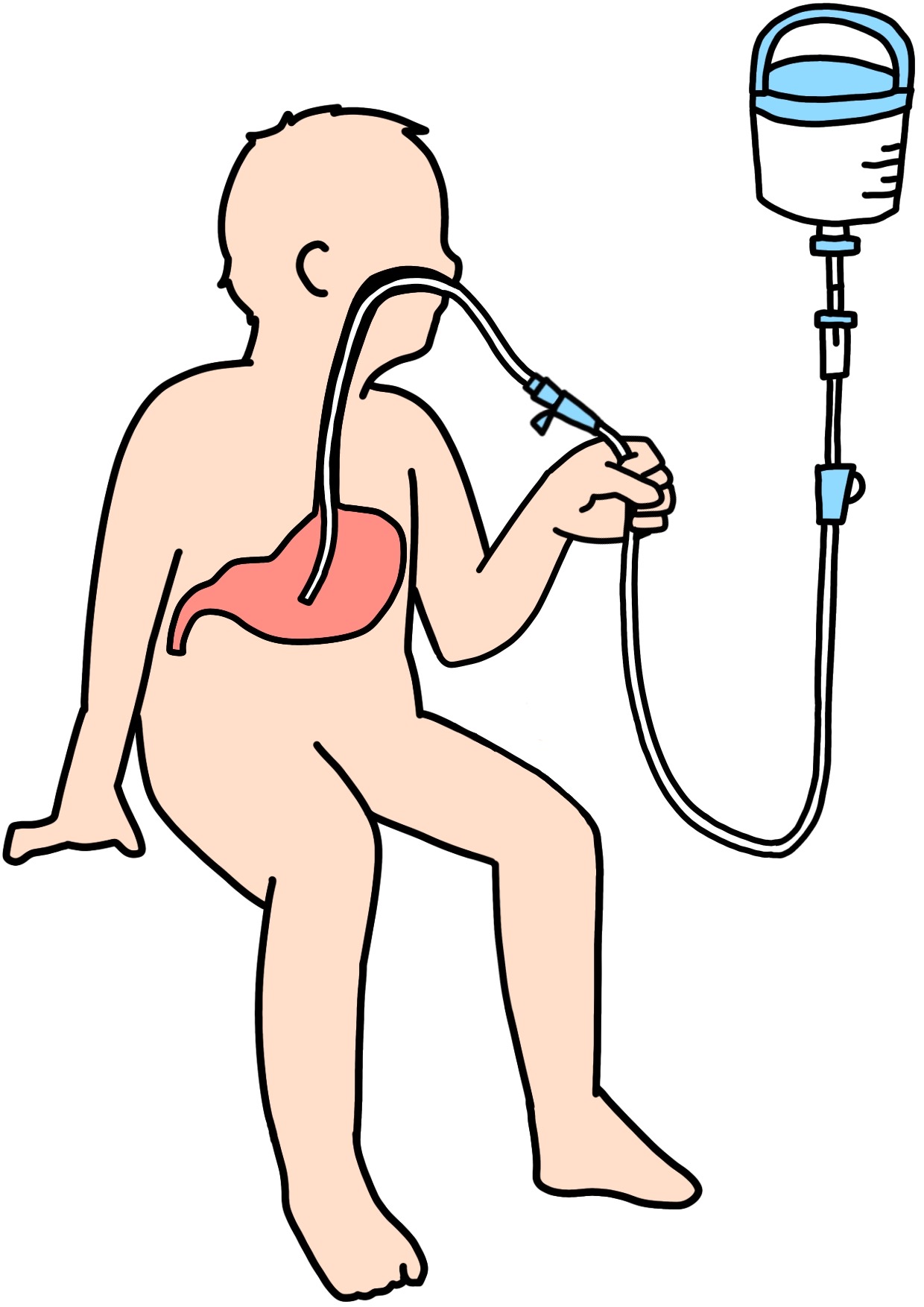 看護記録の書き方の実例　経鼻胃管自己抜去事故